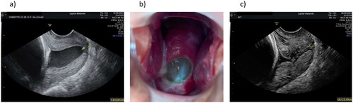 Figure 1. (a) Sonographic cervical evaluation at 31 0/7 gestational weeks. The cervical length is 6.1 mm with funneling; (b) Fetal membranes visible at the external os; (c) Sonographic cervical evaluation at 32 0/7 gestational weeks. The cervical length is 21.9 mm.