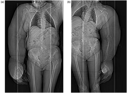 Figures 3. (a,b) CT scans: Any congenital anomalies (e.g., syndactyly) were not found, except the bilateral, disproportional overgrowth of the upper extremities.