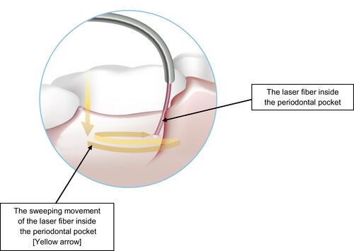 Figure 10 Illustrates the spiral movement of the laser fiber (arrow in yellow) inside the periodontal pocket by which 14 of the selected studies in this systematic review utilized.