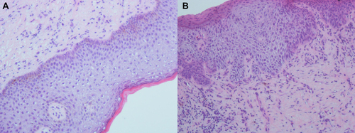 Figure 2 (A and B) Basophilic cell-forming tumor masses can be seen, with dense cellular arrangements and a lack of the classic fenestrated arrangement around them. (Hematoxylin and eosin;×20).