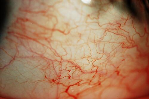 Figure 2 Bulbar conjunctival vessels tortuosities and micro-aneurysms.