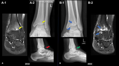 Figure 1 Comparative images: (A) Two sets of ankle radiographs (MRI A-1, Plain XR A-2) AP and lateral views first in 2018 showed mild ankle joint effusion (red arrow) and small tibial plafond subchondral cystic changes (yellow arrow). (B) 2022 follow-up radiographs (Plain XR B-1, MRI B-2) showed progressive changes with multiple large subchondral cysts involving the ankle joint opposing articular surfaces (blue arrows) as well as secondary osteoarthritis with osteophyte formation (green arrow) and reduced ankle joint space. Ankle MRI-selected images coronal PD FS are illustrating the progression of the articular pathology, increase the number of subchondral cysts.