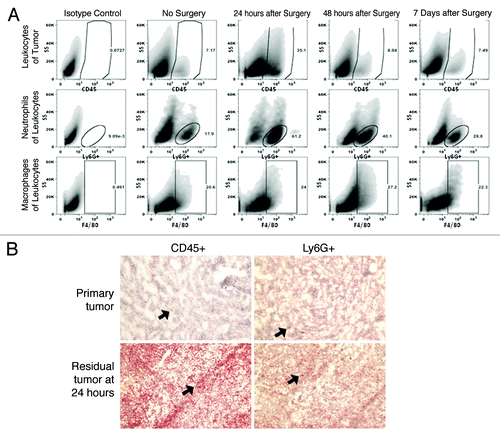 Figure 2. The positive margin model of local recurrence generates a surgical microenvironment that resembles a human surgical field. (A) Representative flow tracings of mice bearing AB12 tumors. Leukocytes (CD45+), neutrophils (CD45+, CD11b+, Ly6G+) and macrophages (CD45+, CD11b+, Ly6G-, F4/80+) were quantified. Gating was performed using a viability probe, followed by selecting CD45+ cells. Surgical site (at 24 h, 48 h, and 7 d following positive margin surgery) was compared with an established tumor (no surgery). (B) Immunohistochemical analysis of the microenvironment of recurrent tumors compared with primary tumors demonstrates the difference in infiltrating immune cells particularly neutrophils. Black arrows indicate leukocytes in the left hand column and neutrophils in the right hand column in primary tumors (at the time of surgery) vs. residual tumors (24 h after surgery).