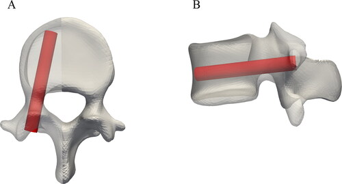 Figure 2. Illustration of a representative example of a standard, clinically suitable screw position defined by an expert spine surgeon in an L4 vertebrae.