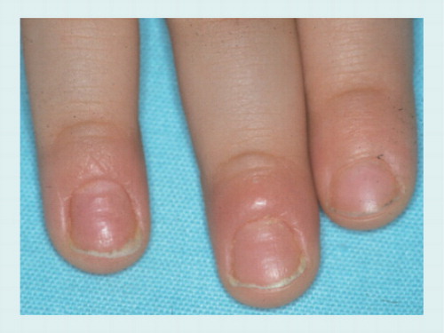 Figure 16. Paronychia due to finger sucking of two fingers in a 1-year-old boy: swelling and mild erythema of the proximal nail folds, absent cuticles and an irregular nail plate surface can be seen.Isolation of Candida indicates secondary colonization and not primary invasion.