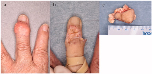 Figure 1. (a) The yellow aspect of the mass was translucent through the skin. (b). A 2.2-cm × 2.0-cm skin defect remained in the middle finger. (c) Resected tumour comprising a chalky substance.
