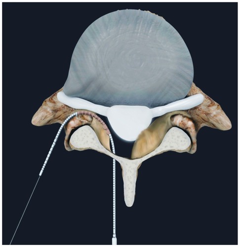 Figure 3 After the probe has been properly inserted and the wire has been delivered, the iO-Flex® MicroBlade Shaver® is passed through the epidural space and out of the lateral foramen.Note: Tissue is removed using a bimanual reciprocating motion.