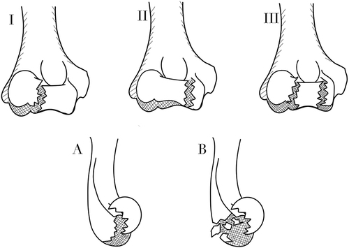 Figure 3 Illustration of the Dubberley classification for capitellar and trochlear fractures. Type I: fractures of the capitellum with/ without lateral trochlear ridge, type II: Fractures of the capitellum and trochlea as one piece, III: fractures of the capitellum and trochlea as separate fragments. In addition to (A) Without posterior wall comminution, (B) with posterior wall comminution.