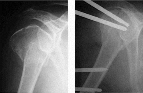 Figure 2. A 3-part fracture preoperatively and after 4 weeks.