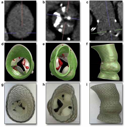 Figure 6. The potential application of 3D printing to design aortic root starting from the computed tomography cross-sectional view, followed by the 3D computational Model to finally obtain a 3D-Printed phantom (with permission from [Citation121]).
