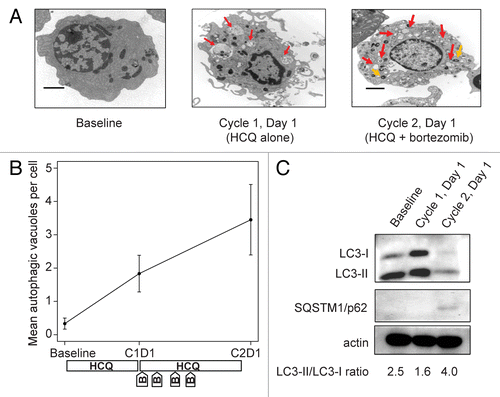 Figure 2. Therapy-associated autophagy modulation in myeloma cells from a patient treated with hydroxychloroquine 400 mg daily and standard bortezomib. (A) Representative electron micrographs of CD138-selected bone marrow plasma cells. Red arrows indicate AVs; orange arrows indicate mitochondria. Scale bar: 2 µm. Samples were obtained from a single patient (patient 13, on dose cohort 4) prior to treatment (baseline), after the 2-wk HCQ run-in on d 1 of cycle 1, and prior to therapy on d 1 of cycle 2. (B) Quantification of AVs in bone marrow plasma cells from patient 13 obtained at baseline, d 1 of cycle 1 (C1D1), and d 1 of cycle 2 (C2D1). Vacuole counts from 2 assessors blinded to patient and time point were averaged, with error bars reflecting the standard error of measurement across 25 cells per sample. The treatment schema shows the timing of administration of daily oral hydroxychloroquine (HCQ) and intravenous bortezomib (B). (C) Immunoblotting of bone marrow plasma cells from patient 13 at the same time points.