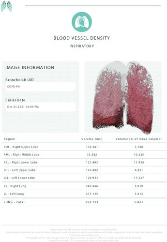 Figure 1 Representative clinical report of blood vessel density with coronal image and summary statistics from a COPD patient,courtesy of FLUIDDA.