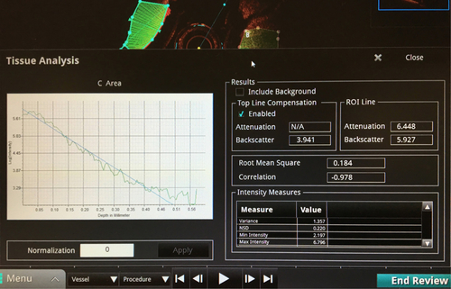 Figure S1 Example for quantification of the OCT images with the ILUMIENTM OPTISTM Offline Review Workstation Tissue Properties Supplement.Notes: The ROIs were drawn in the region of the macrophage cells in the reaction tubes in a semi-automatic way by selecting ROIs beginning at the bottom of the macrophage cell pellets. The software reduced the ROI at the distant side when reaching a lower signal threshold. The values of Attenuation and Backscatter (ROI Line) were used and averaged from five sections of each pellet of the OCT pullbacks.Abbreviations: OCT, optical coherence tomography; NSD, normalized standard deviation.