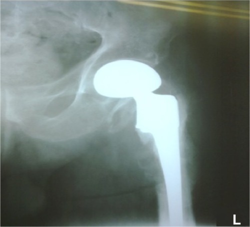 Figure 3 Radiographs showing the remodeling initiated in osteolysis site at month 2 after surgery.Abbreviation: L, left.