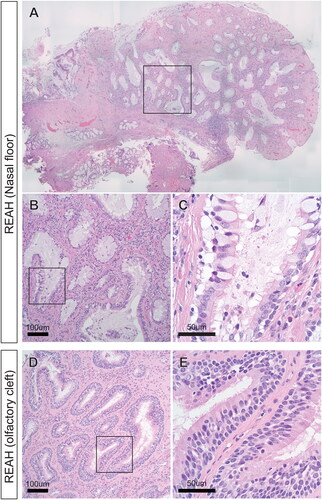 Figure 2. (A) Hematoxylin and eosin staining showed proliferation of glandular elements throughout the mass. (B, C) Magnification showed that the glandular elements were composed of pseudostratified respiratory epithelial cells on a thick basal membrane; these were multiciliated cells (containing motile cilia on their surface) and glandular cells. (D, E) A previously examined respiratory epithelial adenomatoid hamartoma in the olfactory cleft showed similar findings.