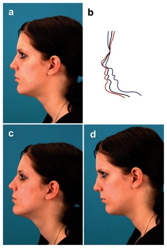 Figure 1 Lateral view of an orthognatic patient with Angle Class 2. The pictures show markedly different profiles. a) Correct position of the patient; b) tracings of photographs a, c, and d; c) the head is bent backward and the Frankfort Horizontal Plane is not parallel to the ground, and the deformity is therefore underestimated; d) the head is bent forward and the deformity is exaggerated.