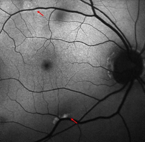 Figure 2 Blue-light autofluorescence of the right eye (left eye not shown) displaying an autofluorescent lesion adjacent to the superior and inferior retinal arcades.