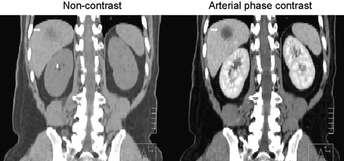 Figure 1.  Exhale breath hold non-contrast and arterial phase IV contrast planning CT-scans of a patient with hepatocellular carcinoma treated during exhale breath hold. The gross tumour volume (GTV) (shown with an arrow) is seen much better on the arterial contrast CT, used for radiation planning.