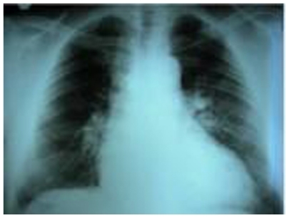 Figure 1 Cardiomegaly and dilatation of right and left lung hilum. Increased vascular shadowing in both sides. Costophrenic regions free of pleural effusion.