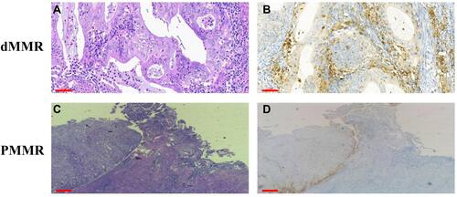 Figure 6 Upregulation of PD-L1 expression in dMMR EC. (A–D) H&E staining and positive membrane staining for PD-L1 in dMMR ECs. H&E, hematoxylin and eosin. Scale bars: 60 μm.