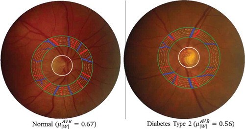 Figure 5. Two typical examples to show the vessel width-based artery and vein diameter ratio (AVR) difference in a specific ROI between one healthy subject and one diabetes type 2 subject. Blue indicates veins and red indicates arteries.