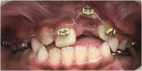 Figure 7. Orthodontic progress photo at three months since initial injury.