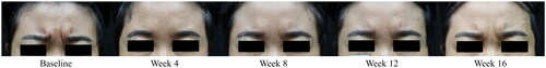 Figure 2. Representative photographs of changes in glabellar wrinkles before and after BMI 2006 injection. Improvement peaked at 4 weeks and gradually decreased over time but remained better than baseline.