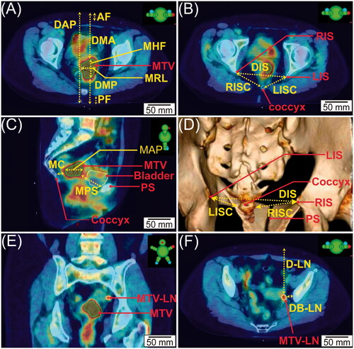 Figure 1. The schematic illustration of pelvic bony landmarks on a representative PET-CT imaging and the anatomical measurements. Figure caption: (A) Axial view that presents the largest cross-section of MTV, MHF, MRL, DMA, DMP, AF, PF, and DAP. (B) Axial view that presents RIS, LIS, coccyx, LISC, RISC, and DIS. (C) Sagittal view that presents the coccyx, PS, MTV, bladder, MC, MPS, and MAP. (D) 3-dimensional reconstruction of bony structures of CT images that illustrates the LIS, RIS, coccyx, PS, DIS, RISC, and LISC. (E) Coronal view demonstrates MTV and MTV-LN. (F) Axial view illustrates the MTV-LN, D-LN, and DB-LN.