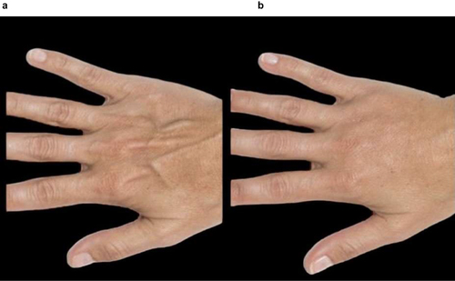 Figure 9 Hands: This 50-year-old female patient was treated with 1.5 mL of Radiesse® + 3 mL of saline (final dilution, 1:2). Radiesse® was delivered via a cannula with 50 mm-length and 25 Gauge-diameter. (a) At baseline, her hand skin thickness was thin (grade 2) and the hand skin laxity and wrinkles were moderate (grade 2 on the Merz scale). (b) The improvement reported at 3 months after 2 sessions of Radiesse® injection was very good (grade 4).