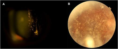 Figure 1 Appearance of asteroid hyalosis in slit-lamp with direct focal illumination (A) and retinal examination here seen using a fundus photography (B).