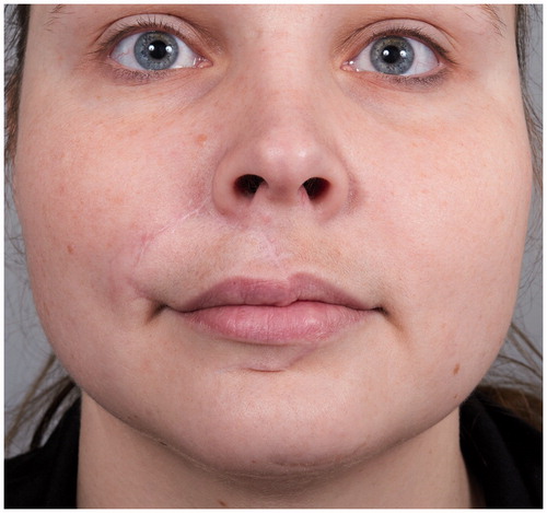 Figure 4. The patient at one year follow-up. The lip still has a slight edema, which is slowly subsiding.