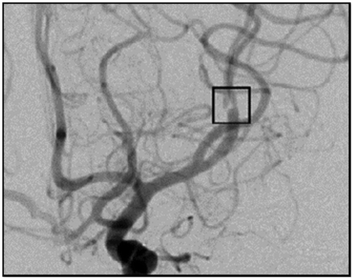 Figure 1. Post-operative anterior/posterior angiographic view of a Figure 8 anastomosis. The translucency at the center of the black box represents the obstruction created by the two vessel walls at the middle of the anastomosis. Used with permission from Barrow Neurological Institute.