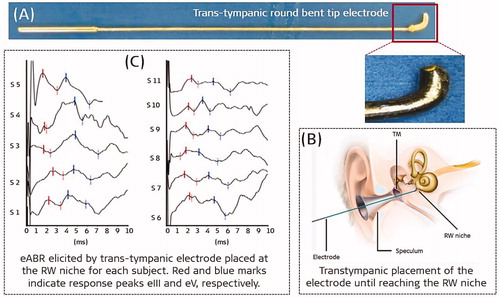 Figure 31. Transtympanic rounded-bent tip electrode that facilitates easy placement at the RW niche (A). Illustrative representation of the transtympanic electrode placement at the RW niche (B). PromStim eABR responses for all eleven patients (C) [Citation27]. Image courtesy of MED-EL.