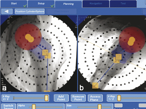 Figure 4. Definition of the safe zone: planning the implant position with the displayed safety cylinder (blue cylinder) and safety sphere (red sphere) in the frontal view (a) and lateral image (b).