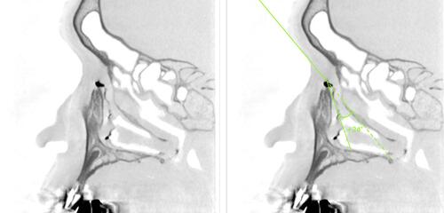 Figure 5 Example of a large SOR–ICP–NLD opening angle. On the left side is the original image. On the right side, a relatively large angle of 24° is seen, which is due to the elevation of the SOR and the anterior inclination of the NLD.
