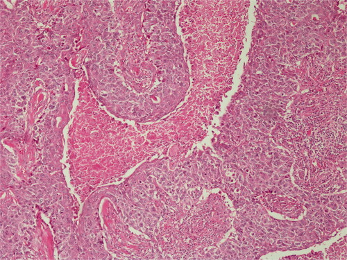 Figure 3. Lobular proliferation is seen. H&E; original magnification, ×100.