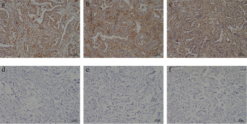Figure 6. Immunohistochemical detection of c-Met expression in NSCLC and its adjacent adjacent tissues. (a) NSCLC clinical specimens IHC with moderate (IHC++), (b and c) NSCLC clinical specimens IHC with strong (IHC+++) staining, respectively. (D ~ F) The paracancerous tissue specimen was negative for c-Met based on IHC analysis(×400).