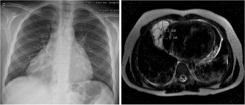 Figure 1. a) Enlargement of mediastinum in the chest radiography; b) MRI showing pericardial cyst in the right hemithorax, measuring 61.6 x 41.3mm.