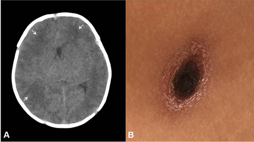 Figure 1 (A) On the first day of admission, the baby was suspected of neonatal bacterial meningitis, and CT showed that patchy low-density areas in the bilateral frontal, temporal and parietal lobes (arrow). (B) On the eighth day of the patient’ mother had fever, the local doctor suspected that she was infected with tsutsugamushi disease, and found an 1.2×0.8 cm eschar on her left groin.