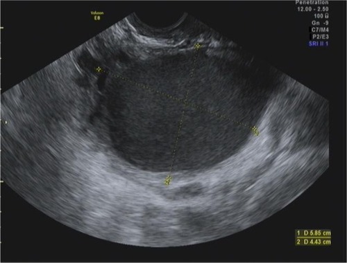 Figure 6 Ovarian cyst observed on transvaginal ultrasound in a 25-year-old woman.