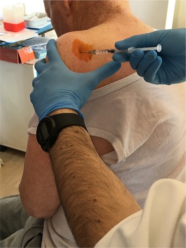 Figure 1 Glenohumeral injection technique with botulinum toxin A.