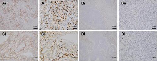 Figure 1 Immunohistochemical staining of ER and PR expressions. (1Ai, 1Aii) (cervical squamous cell carcinoma with stage IB1) and (1Bi, 1Bii) (cervical squamous cell carcinoma with stage IB1) show the positive and negative ERα expression, respectively; (1Ci, 1Cii) (cervical adenocarcinoma with stage IB1) and (1Di, 1Dii) (cervical squamous cell carcinoma with stage IB1) show the positive and negative PR expression, respectively. (1Aii, 1Bii, 1Cii and 1Dii) are the enlarged images of (1Ai, 1Bi, 1Ci and 1Di), respectively. Tumor cells and stromal cells with positive ERα and PR expression display yellow or brown granules in the nucleus.