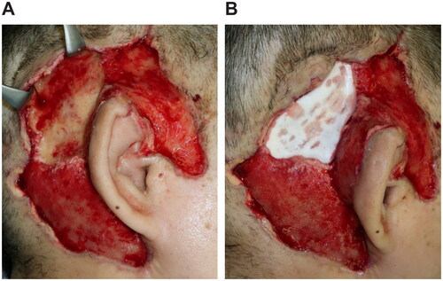 Figure 4. Third surgery, 26 days after. (A) The extracranial plate is removed to the depth where petechial hemorrhage. (B) Artificial dermis (TERUDERMISⓇ, Olympus Terumo Biomaterials Corp) is placed.