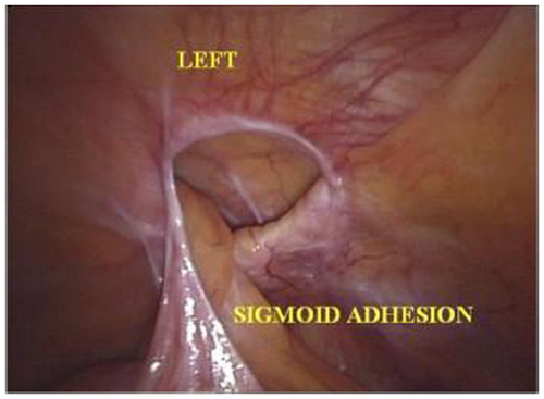 Figure 3 Laparoscopic-robotic view of Spiegel’s hernia, with the hernia ring and incarcerated epiplon and the part of sigmoid colon in the hernial pouch.