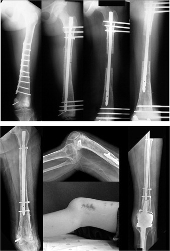 Figure 3 (case 19). The patient experienced femoral shortening after the limb salvage operation, which involved irradiation of the osteosarcoma of the distal femur. Lengthening over a nail was done, and 7.7 cm was gained. Although satisfactory lengthening was achieved, severe knee subluxation occurred with stiffness which was probably due to deficiency of cruciate ligaments. Arthroplasty was performed in this patient.