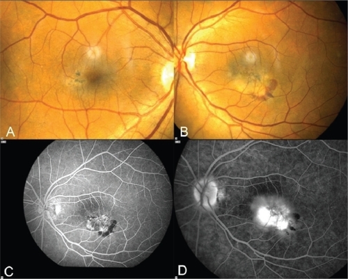 Figure 1 A) Right eye: Color fundus picture showing slightly dilated right-angle veins with retinal pigment epithelium hyperplasia beneath them. B) Left eye: Color fundus picture showing subretinal hemorrhage inferior and temporal to the fovea. C) Venous phase of FA of the LE depicts early hyperfluorescence corresponding to the neovascular membrane and hypofluorescence inferior to the membrane corresponding to the subretinal hemorrhage. D) Late phase of FA showing leakage from the neovascular membrane.Abbreviations: FA, fluorescein angiography; LE, left eye; OCT, optical coherence tomography.