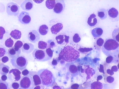 Figure 2. Bone marrow aspirate showing hemophagocytosis along with a fair number of plasma cells and normoblasts in case of infection (Jenner–Giemsa, ×100).
