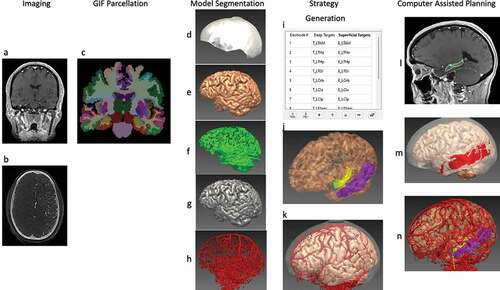 Figure 2. CAP image processing pipeline: imaging modalities required for CAP include a reference image – a Gadolinium-enhanced T1 (a), and a vascular imaging modality – here an intracranial digital subtraction angiogram (DSA) (b). A whole brain GIF parcellation is generated from the reference image (c). A model of the skull is generated from the reference image and cropped to represent areas that are feasible for implantation (d), while models of the cortex (e), sulci (f), and gray matter (g), are automatically extracted. Vascular models are created from the raw DSA images following filter application and mesh cleaning (h). The implantation strategy entry and target points are then selected and derived from the whole brain parcellation (i), and brain ROIs are automatically segmented (j). In this case, the amygdala (blue) and hippocampus (yellow) are shown as target regions, and the middle temporal gyrus (purple) as the entry region. (k) is a composite image of the cortex, vasculature and skull mask. Trajectories that exceed angle, length and critical structure restrictions are removed from consideration. Risk maps for the target structure (that for hippocampus shown in (l) and corresponding safe entry zones (m) are created and electrode trajectories displayed, with vasculature, cortex, target and entry points in (n). ROI = region of interest. Note: for clarity, only temporal electrodes are shown.