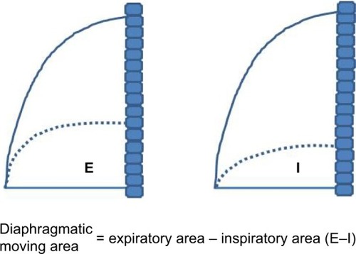 Figure 2 Schematic illustration of the area displaced by diaphragm movement during both inspiration (Area I) and expiration (Area E) in patients with chronic obstructive pulmonary disease.