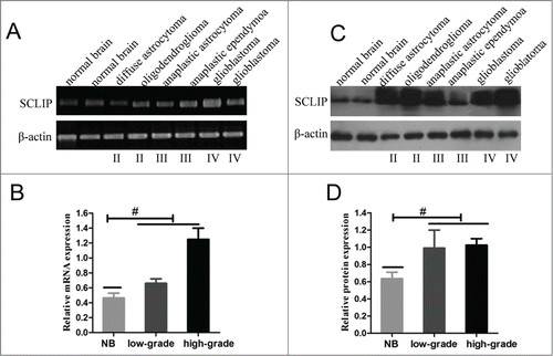 Figure 1. SCLIP levels were increased in glioma samples compared with normal brain tissues. (A)and B). RT-PCR was used to determine the mRNA levels of SCLIP in normal brain tissues (NB) and glioblastomas(Grade IV), anaplastic astrocytoma(Grade III), anaplastic ependymoma(Grade III), diffuse astrocytoma(Grade II) and oligodendroglioma(Grade II). β-actin was used as a loading control. #P < 0.05. low-grade: Grade II; high-grade: Grade III and IV. (C)and D) Western blots were performed to assess the protein levels of SCLIP in normal brain tissues, high-grade and low-grade gliomas. #P < 0.05.